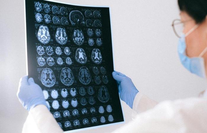 Questo test rivoluzionario in grado di rilevare i primi segni di demenza