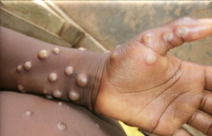 Af’Sud: un’epidemia di Mpox lascia un morto | APAnews