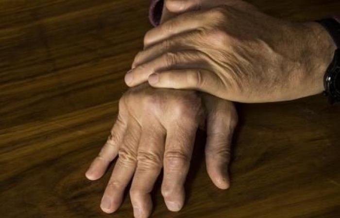 un quarto dei pazienti ha anche problemi di artrite