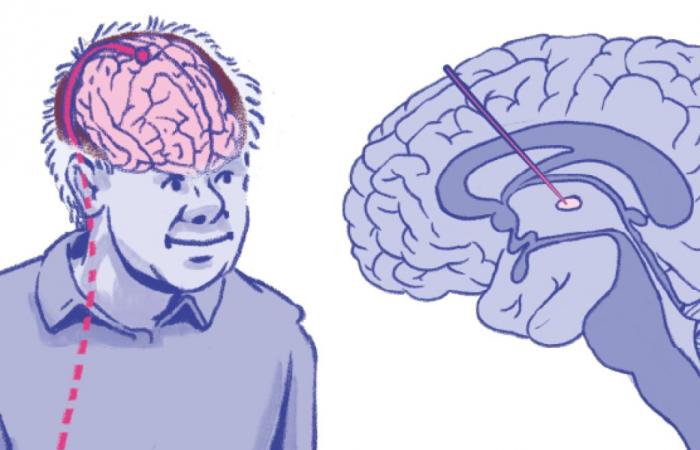 Ridurre gli effetti della malattia di Parkinson attraverso il trattamento intracerebrale