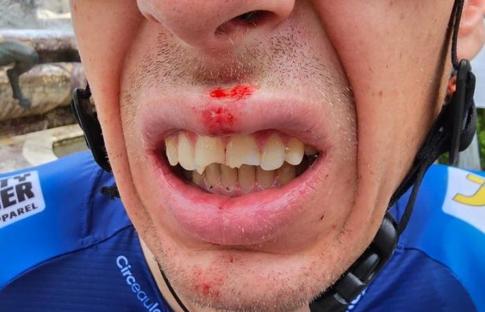 Tour de France 2024: “Tre denti rotti!” Il grande incidente di un corridore poco prima della partenza della Grande Boucle