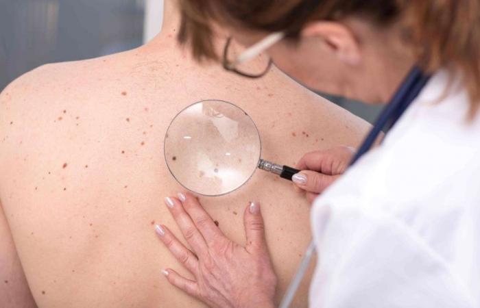 Come riconoscere i primi segni di cancro della pelle?