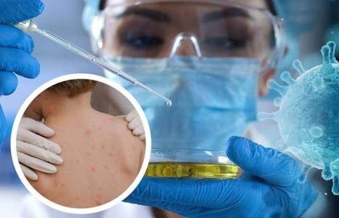 Il
      Marocco
      registra
      il
      primo
      caso
      di
      Mpox