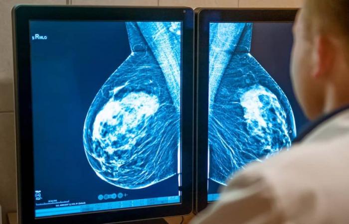 Aumentano i casi di cancro al seno tra le donne sotto i 50 anni