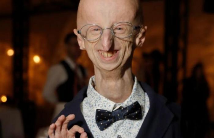 Cos’è la progeria, questa malattia per cui si può morire di vecchiaia a 13 anni?