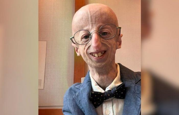 È morto all’età di 28 anni Sammy Basso, il paziente più anziano del mondo affetto da invecchiamento precoce