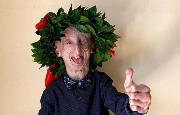 È morto Sammy Basso, il malato di progeria il più longevo al mondo