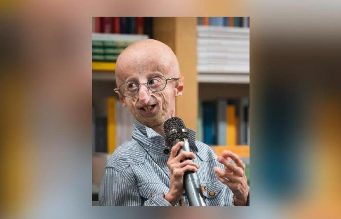 Il paziente affetto da invecchiamento precoce, che era il più anziano del mondo, è morto a 28 anni