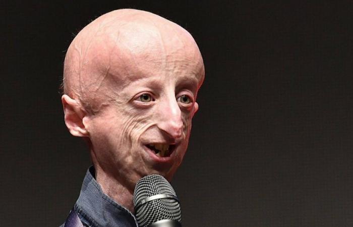 aveva 28 anni. Era il malato di progeria più longevo al mondo