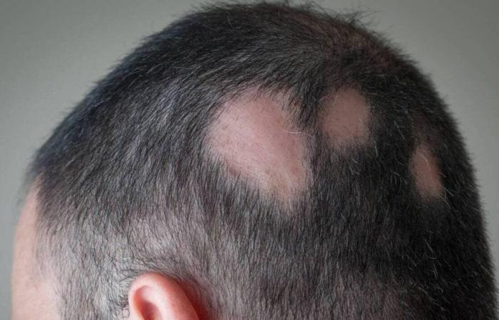 nuove molecole per trattare l’alopecia areata