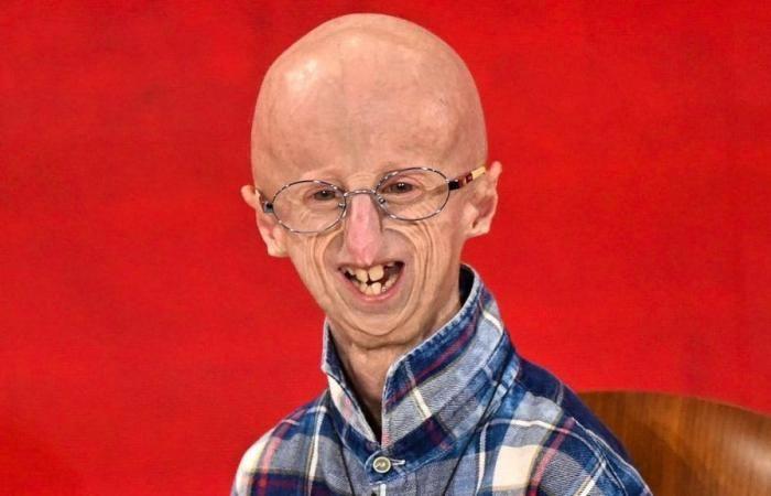 La vittima della progeria muore all’età di 28 anni