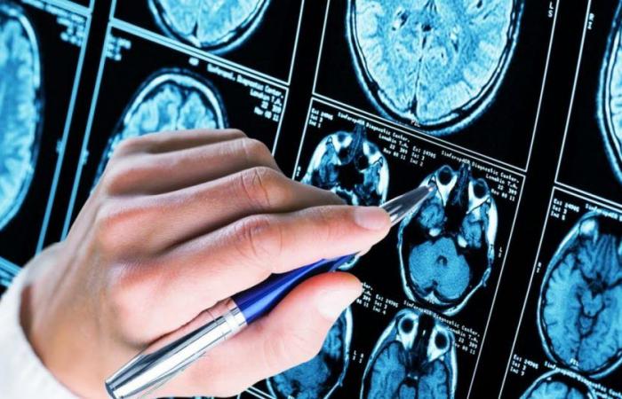 Malattia neurodegenerativa. Vero o falso: nove domande sull’Alzheimer