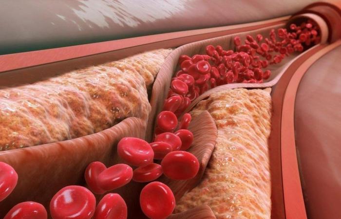 Una nuova terapia con nanoparticelle pulisce le arterie dall’interno