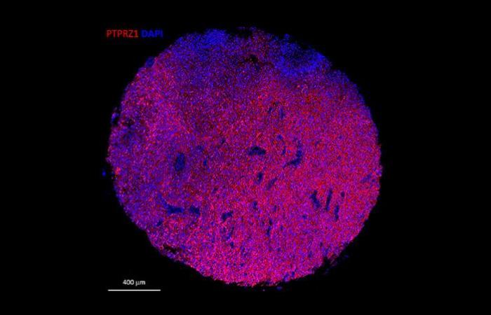 Queste cellule geneticamente modificate attaccano i tumori