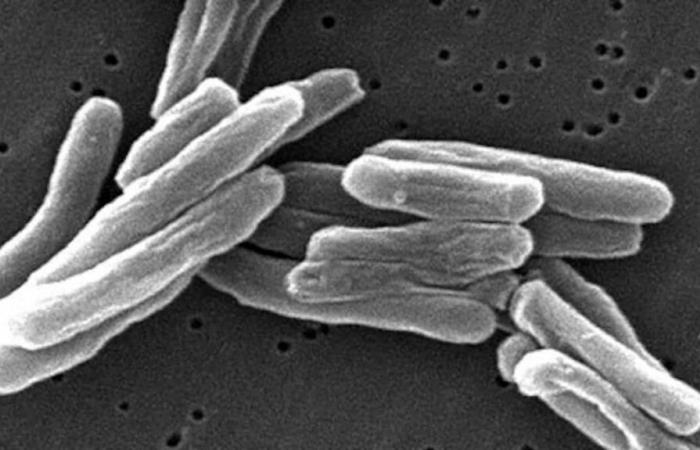 Forte aumento del numero di casi di tubercolosi in Quebec