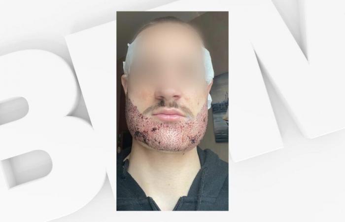 studente si suicida dopo un trapianto di barba fallito a Türkiye