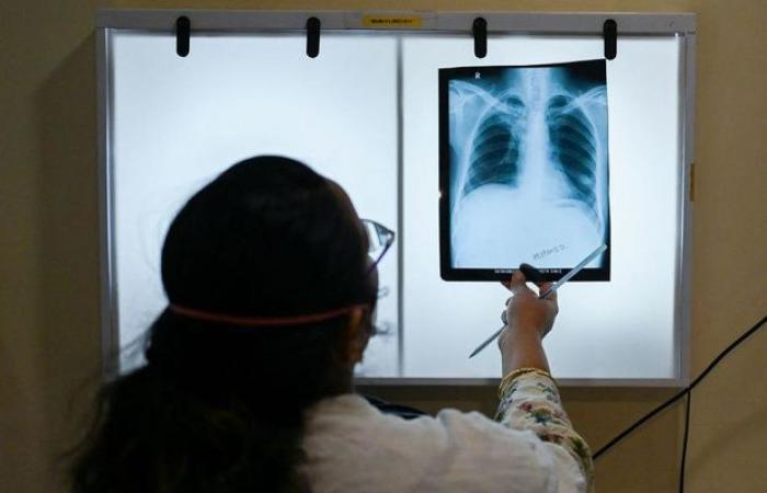 Oms: nuovo record mondiale di casi di tubercolosi nel 2023