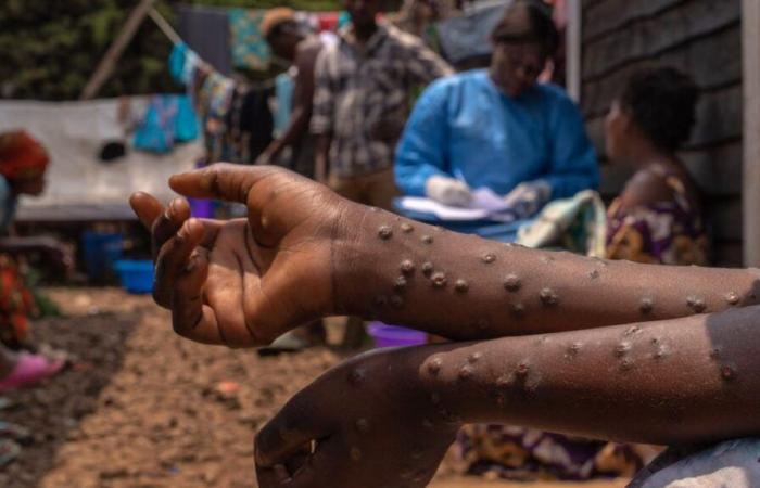 Mpox: lieve rallentamento della contaminazione in Africa