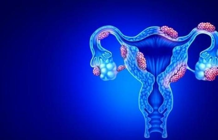 Endometriosi: una scoperta potrebbe spiegare il dolore e la crescita delle lesioni