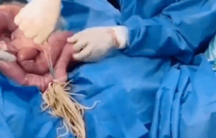 I medici gli rimuovono un centinaio di vermi intestinali dal colon