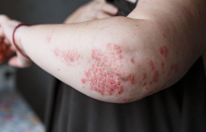 Zasocitinib, un altro inibitore di Tyk2 per il trattamento della psoriasi orale