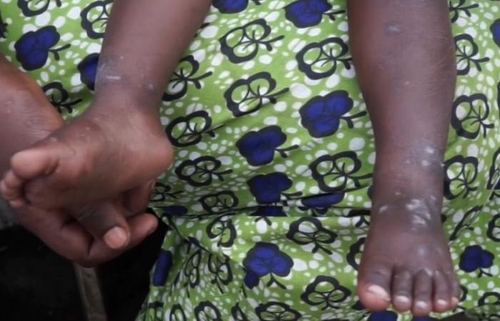 Mpox: l’epidemia in aumento tra i bambini nella RDC e in Burundi