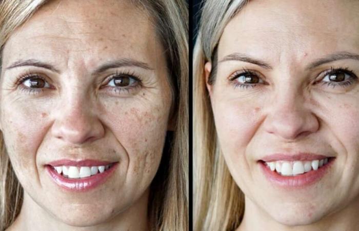 Ho testato il trattamento IPL per la rosacea e le macchie ed ecco la mia opinione