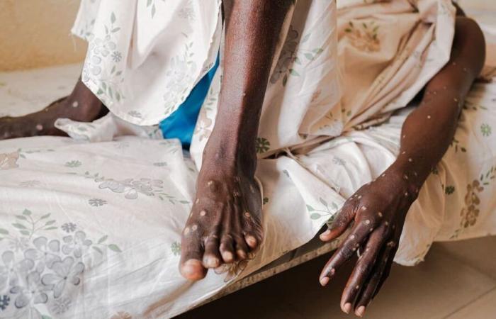 Mpox: l’agenzia sanitaria dell’Unione Africana approva il primo test PCR africano