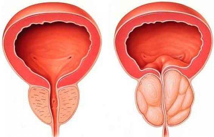 Screening del cancro alla prostata: lancio della campagna “Novembre Blu”.