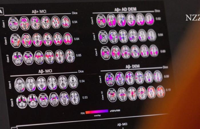 Il farmaco contro l’Alzheimer Leqembi sarà presto disponibile nell’UE