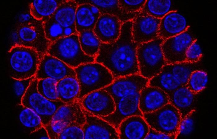 Esplosione nelle cifre del cancro al pancreas: “C'è sempre speranza” per Fabienne Portales, oncologa dell'ICM-Val d'Aurelle