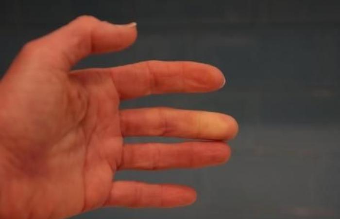 Hai le mani fredde? Questo test di 1 minuto ti dirà se hai la sindrome di Raynaud