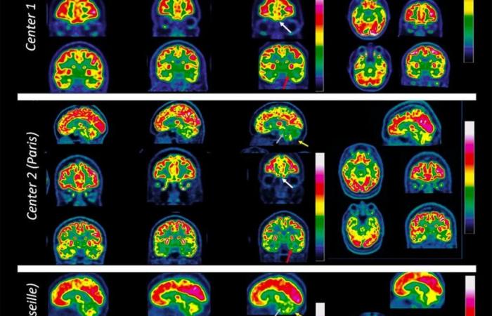 Quello che sappiamo sull’impatto del Covid sul cervello