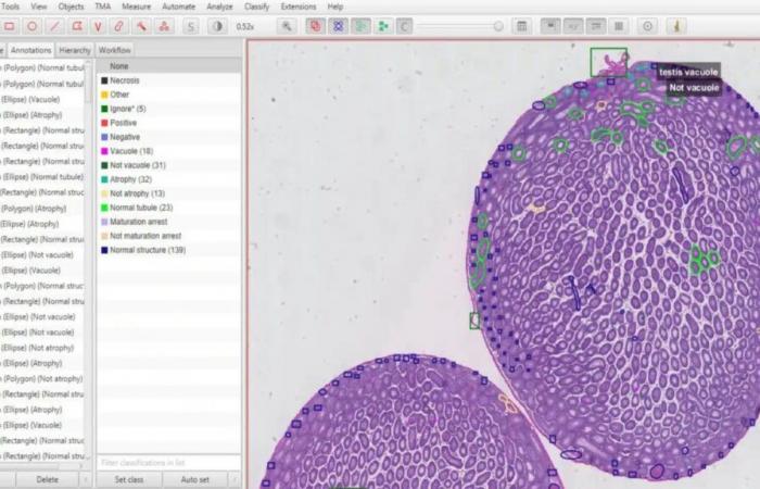 Questa intelligenza artificiale rileva il cancro in pochi minuti