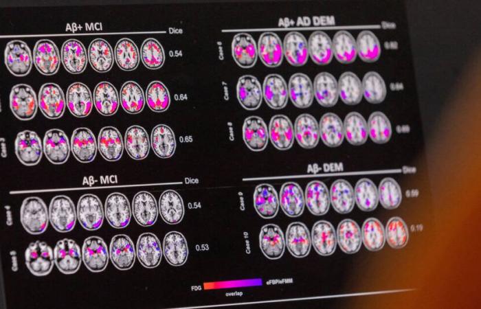 E se l’Alta Autorità della Sanità si dimostrasse indipendente sui farmaci anti-Alzheimer? – Liberazione