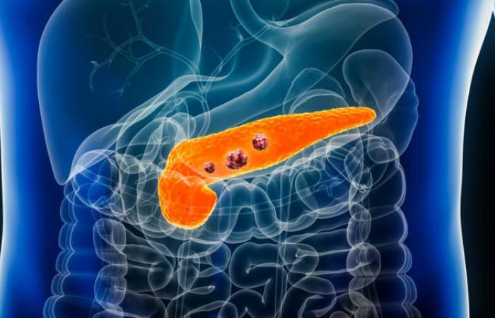 La piaga del cancro al pancreas