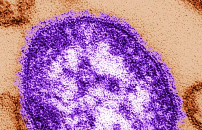 Il bilancio delle vittime dell’epidemia di morbillo in NB raggiunge 44 casi, principalmente giovani