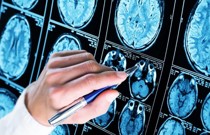 TRAUMA CEREBRALE e ALZHEIMER: qual è il collegamento?