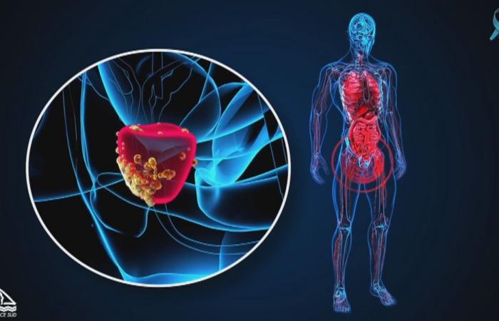 Sei cose da sapere sul cancro alla prostata in Nuova Caledonia