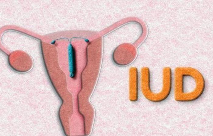 IUD ormonale e rischio di cancro al seno