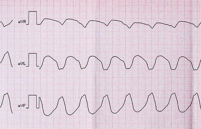 ablazione di prima linea, un’opzione difendibile