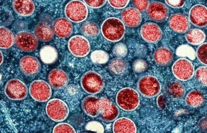 I virus dell’influenza aviaria Mpox e H5N1 continuano a diffondersi