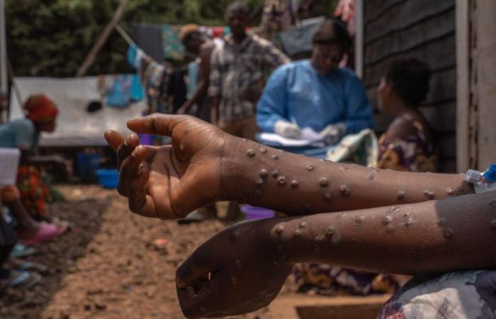 Mpox nella RDC: l’OMS mantiene il livello di allerta più alto | APAnews