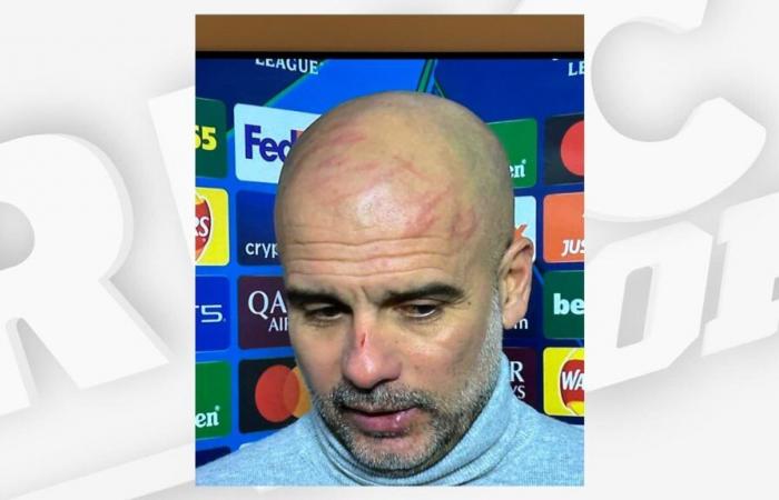 i graffi spaventosi sul volto di Guardiola dopo il pareggio del Manchester City contro il Feyenoord