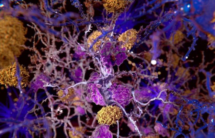 un nuovo trattamento causerebbe una (benefica) perdita di volume cerebrale