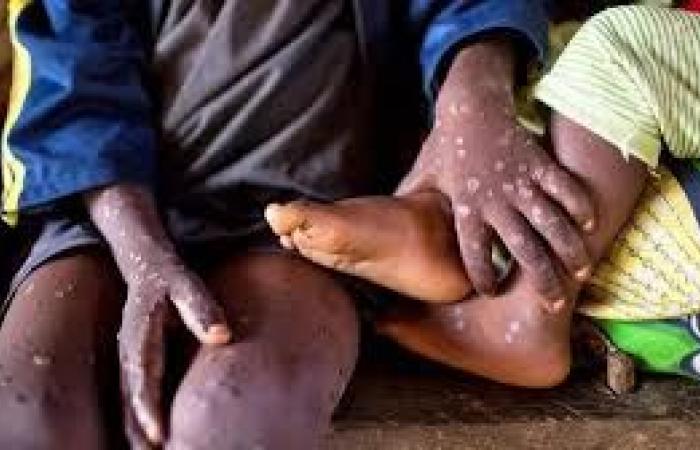 20 paesi africani colpiti dal virus Mpox (Africa CDC) | APAnews