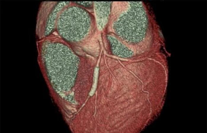 Dopo il posizionamento dello stent, clopidogrel è preferibile all’aspirina a lungo termine nei pazienti a rischio