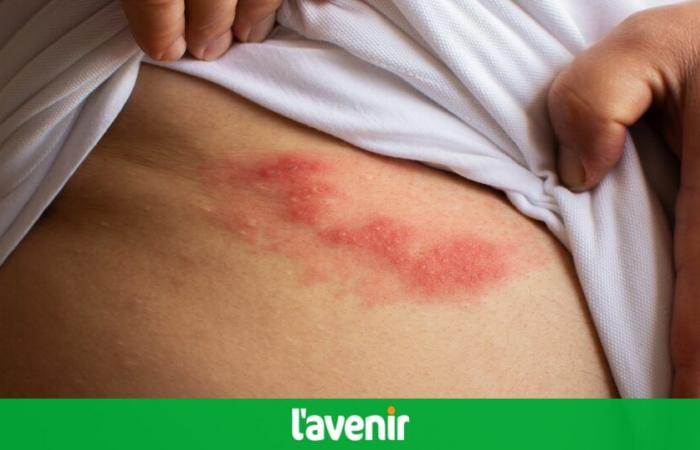 Più di un adulto su cinque è infetto dal virus dell’herpes genitale: “Servono migliori prevenzione e trattamenti”