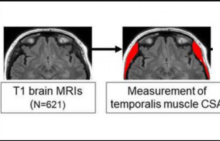 La perdita dei muscoli temporali potrebbe essere un segnale di allarme dell’Alzheimer