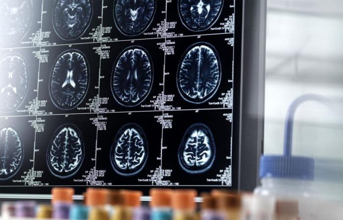 Alzheimer: una svolta importante